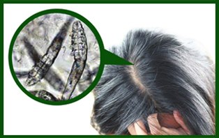 Treat Demodex Hair Mites To Stop Hair Loss